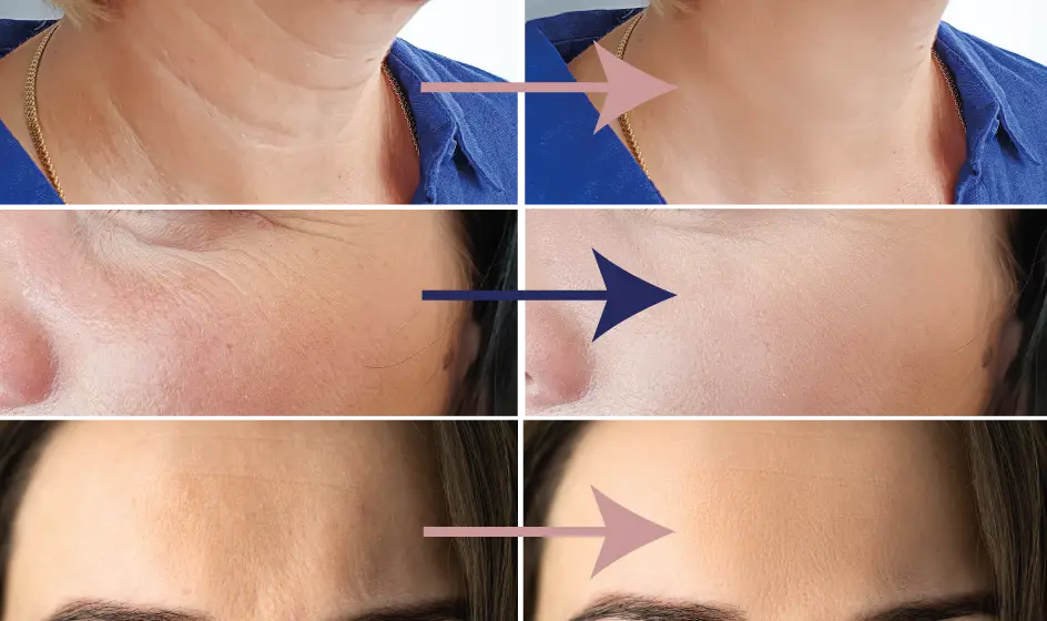 Wrinkare device for face and neck
